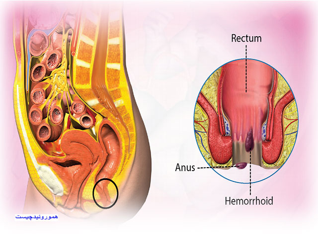 هموروئید چیست و چگونه درمان میشود؟ 