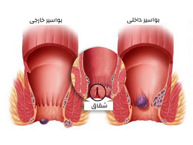 هموروئید و فیشر چیست؟